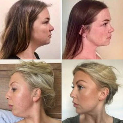 Masajeador Reductor y Rejuvenecedor Facial - RenovaSkin Pro