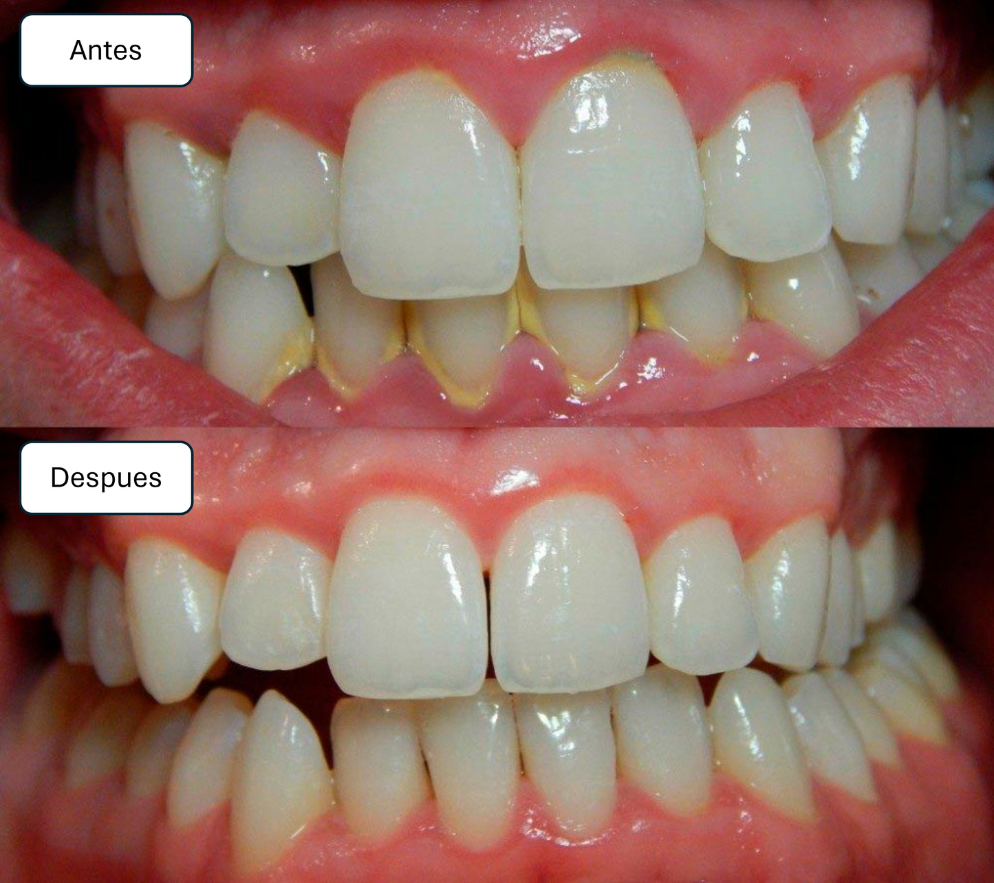 Limpiador Dental Ultrasónico